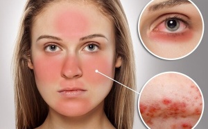 Phụ nữ bị lupus nên làm gì khi mang thai để giữ sức khỏe?