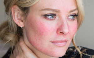 Làm sao để cải thiện chứng rosacea (hồng ban)
