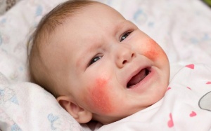 Làm sao biết trẻ có bị dị ứng với thuốc hay không? 