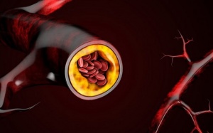 Tại sao bạn nên cảnh giác với bệnh động mạch vành?