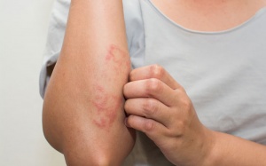 Cách đối phó với bệnh chàm ở mọi lứa tuổi