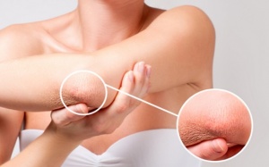 Một số biến chứng đái tháo đường trên da thường gặp nhất