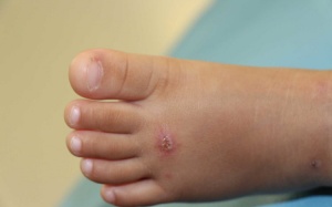 Trẻ bị mụn cóc ở chân phải làm sao? 