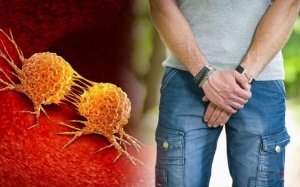 5 dấu hiệu cảnh báo ung thư tuyến tiền liệt không được bỏ qua