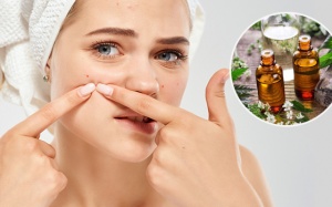 Dùng tinh dầu để trị mụn trứng cá cần lưu ý gì, cách dùng thế nào?
