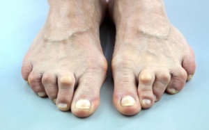 8 dấu hiệu nhận biết viêm khớp ngón chân