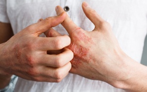 Vỏ cây núc nác và các biện pháp tự nhiên giúp giảm bệnh chàm