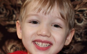 Nguyên nhân nào khiến răng sữa của trẻ bị đổi màu?