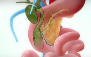 Nang ống mật chủ là gì, có triệu chứng gì cảnh báo?