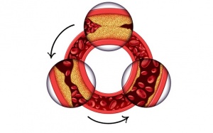 Liệu có cách nào trì hoãn bệnh động mạch vành?