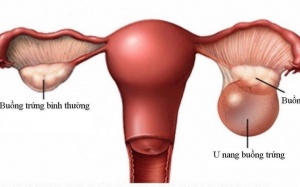 Đau bụng, rong kinh do u nang buồng trứng không còn là nỗi lo
