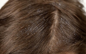 Bị khô da đầu vào mùa đông phải làm thế nào?