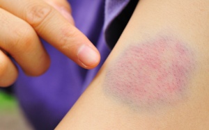 Chuyên gia dinh dưỡng chỉ ra 6 dấu hiệu cơ thể đang thiếu hụt vitamin 