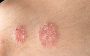 8 cách đơn giản giúp hỗ trợ điều trị vảy nến