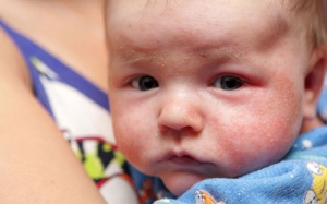 Cách phòng bệnh chàm bùng phát ở trẻ trong mùa Đông