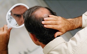 Tại sao đàn ông lại bị hói đầu?