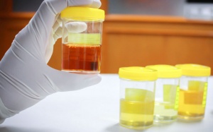 Nước tiểu màu vàng cam có thể cảnh báo ung thư tuyến tụy