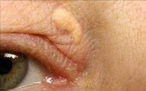 Có nên ngừa tích tụ u vàng cholesterol vùng mắt bằng TPCN?