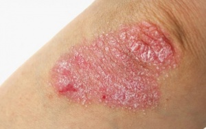 Những điều có thể bạn chưa biết về bệnh vảy nến
