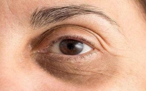 5 biện pháp tự nhiên giúp giảm quầng thâm mắt