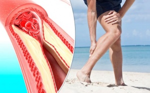 Người bệnh đái tháo đường cần cẩn thận với bệnh động mạch ngoại biên