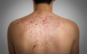 Mụn lưng – 4 nguyên nhân và cách khắc phục