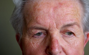 Làm thế nào để cải thiện tình trạng hồng ban cánh mũi của chồng tôi?