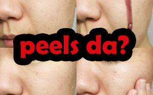 Peels da hóa học liệu có an toàn và hiệu quả?