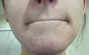 Trị dứt điểm mụn đầu đen ở cằm ngay tại nhà