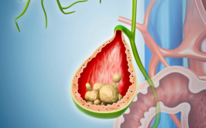 Sỏi túi mật 14mm dùng TPCN Kim Đởm Khang có tan sỏi được không?