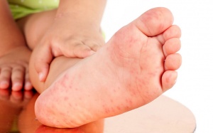 Triệu chứng mới của Covid-19: Cảnh giác với những vết bầm tím ở ngón chân của trẻ