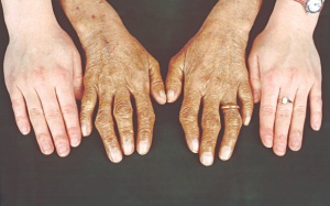 7 biến chứng nguy hiểm do thừa sắt trong cơ thể