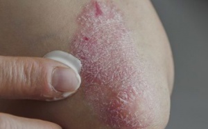 10% dân số sẽ phát triển bệnh chàm trong cuộc đời 