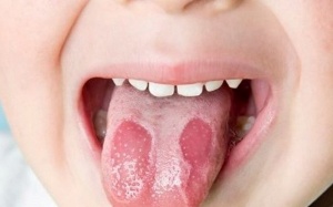 Dấu hiệu bất thường ở lưỡi cảnh báo bệnh mạn tính nguy hiểm