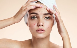 5 loại thực phẩm gây mụn trứng cá 