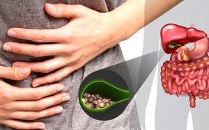 Sỏi đường mật trong gan dạng bùn có uống được TPCN Kim Đởm Khang?