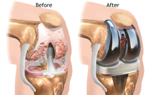 Lời khuyên giúp người già “sống chung” với khớp gối nhân tạo
