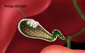 Polyp túi mật 7mm có cần lo lắng?