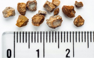 10 biện pháp tự nhiên giúp đánh tan sỏi thận, sỏi tiết niệu