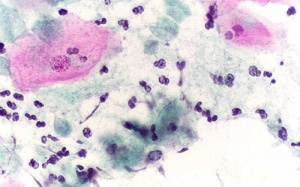 Candida: Sinh vật “thèm” đường gây tăng cân, béo phì