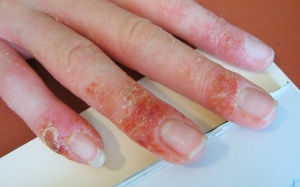 5 phương pháp điều trị bệnh chàm bác sỹ da liễu khuyên dùng