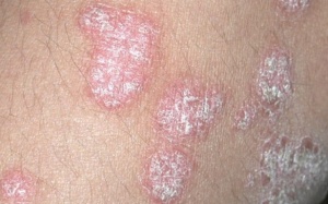 Bệnh vảy nến ảnh hưởng đến phổi như thế nào?