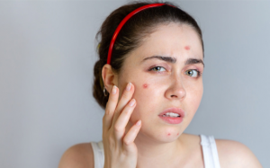 Không chỉ thức ăn nhiều mỡ, chocolate và sữa cũng có thể gây mụn