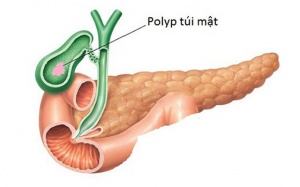 Polyp túi mật có thể tự biến mất không?