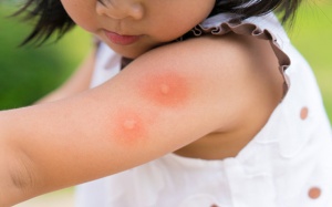 6 mẹo chữa ngứa, giảm sưng khi bị muỗi đốt