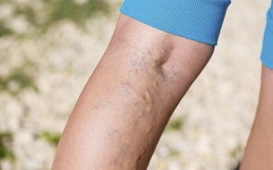 Giảm đau khi bị giãn tĩnh mạch chân tại nhà bằng cách nào?