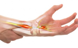 Bệnh suy giáp làm tăng nguy cơ mắc hội chứng ống cổ tay?