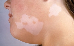 6 biến chứng về da do bệnh đái tháo đường bạn nên biết