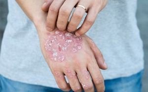 Dầu cá có giúp điều trị bệnh chàm?