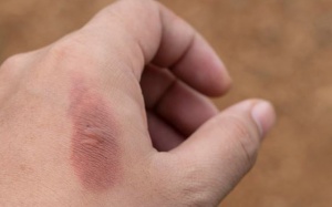 Mách bạn cách trị vết sẹo do bỏng tại nhà đơn giản